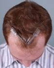 Before Hair Transplant&nbsp;Hairlines